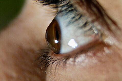 keratoconus
